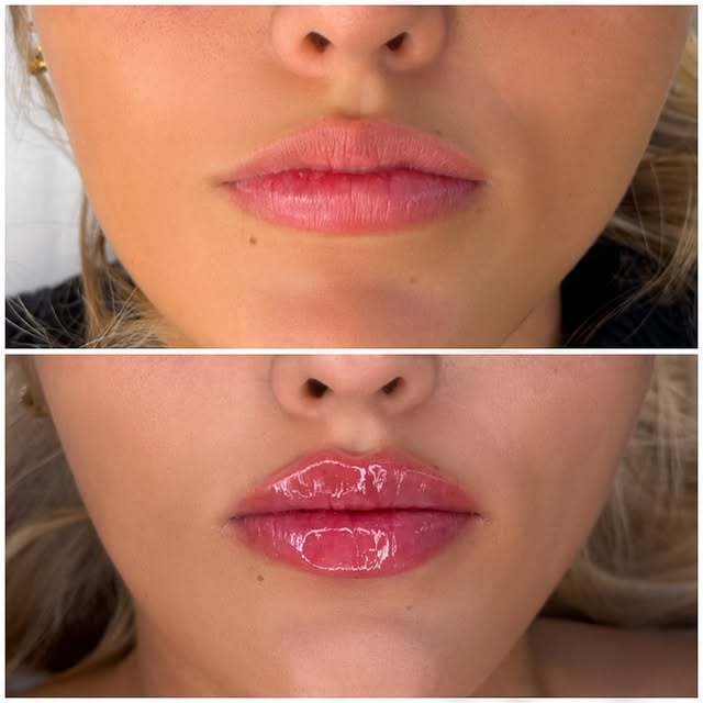 Russian Lips læbeforstørrelse – før og efter