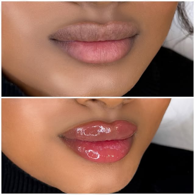 Russian Lips læbeforstørrelse – før og efter