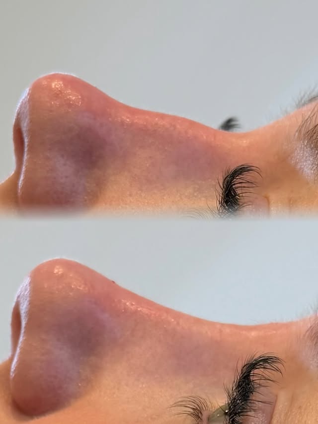 Næsekorrektion med filler – før og efter