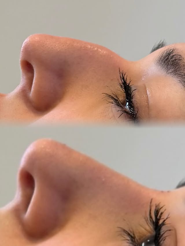 Næsekorrektion med filler – før og efter