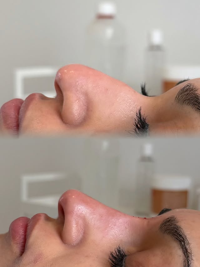 Næsekorrektion med filler – før og efter